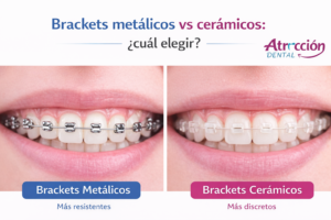Brackets metálicos vs cerámicos