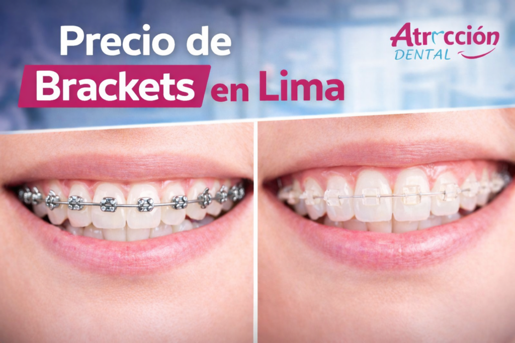 Precio de brackets en lima