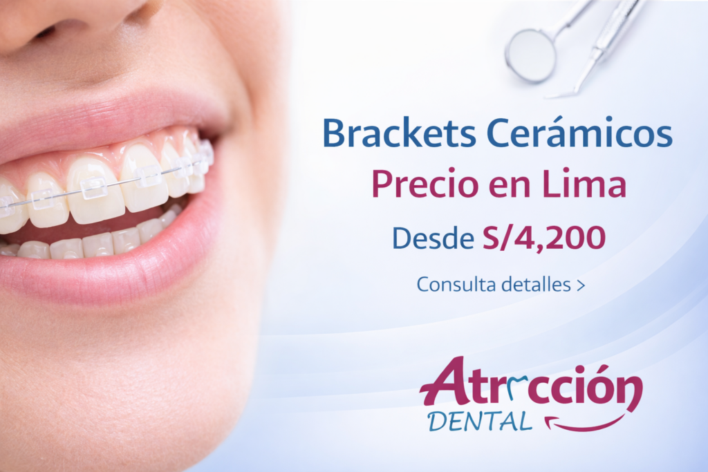 Brackets cerámicos en Lima con sonrisa de paciente y precio referencial desde S/4,200 en Atracción Dental