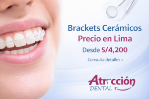 Brackets cerámicos en Lima con sonrisa de paciente y precio referencial desde S/4,200 en Atracción Dental